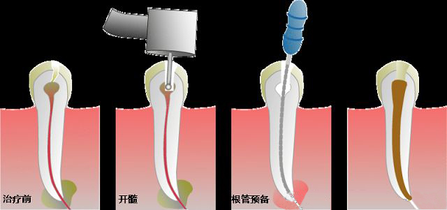 根管治疗