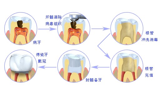 根管治疗