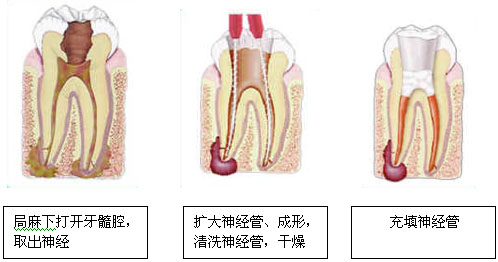 根管治疗