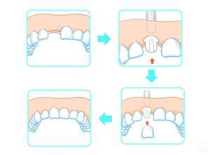 单颗种植牙